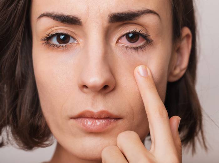 Dry Eye Treatment Boston