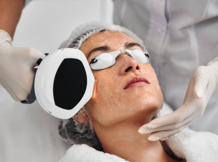 IPL Therapy with Lumecca in Boston