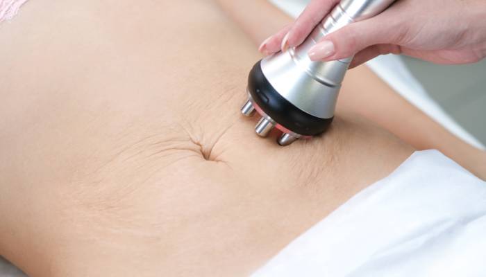 RF Contouring Treatment